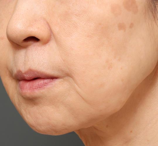 60代女性のシワ・たるみ After 症例写真