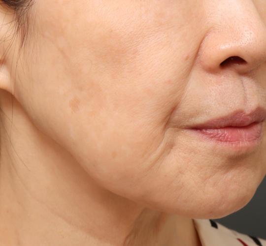 60代女性のスネコス After 症例写真