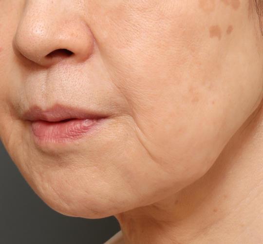 60代女性のシワ・たるみ Before 症例写真