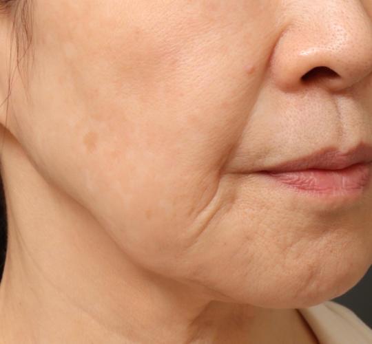 60代女性のスネコス Before 症例写真