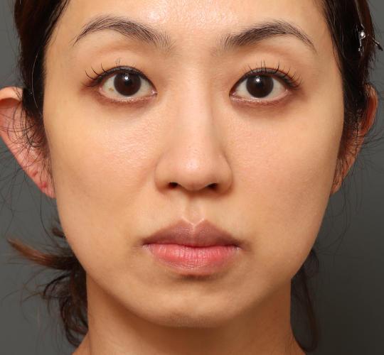 40代女性の3Dリポアイリフト  After 症例写真