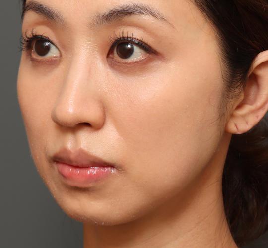 40代女性の3Dリポアイリフト  After 症例写真