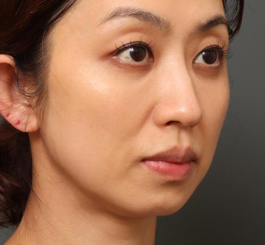 40代女性の3Dリポアイリフト After 症例写真