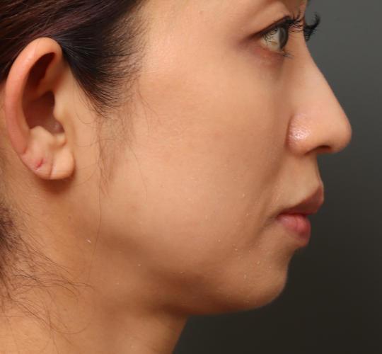 40代女性の3Dリポアイリフト  After 症例写真