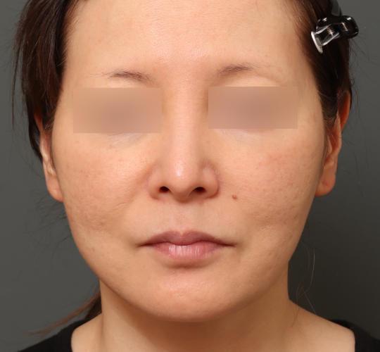 40代女性のスネコス After 症例写真