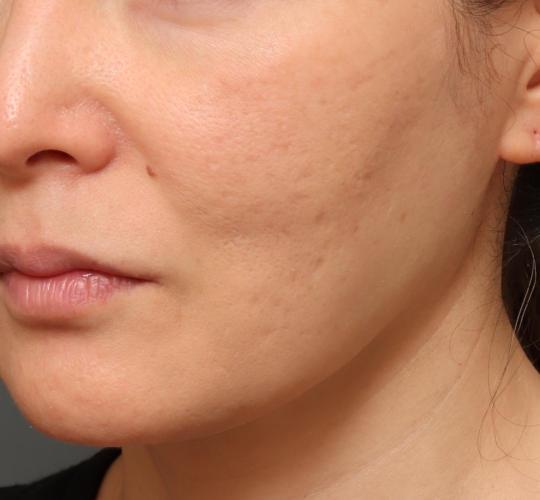 40代女性のシワ・たるみ After 症例写真