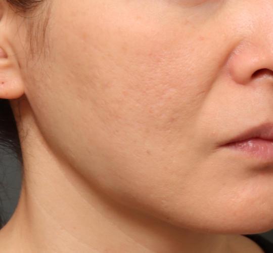 40代女性のスネコス After 症例写真