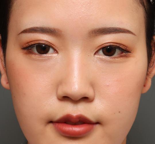 10代女性の目頭切開 After 症例写真