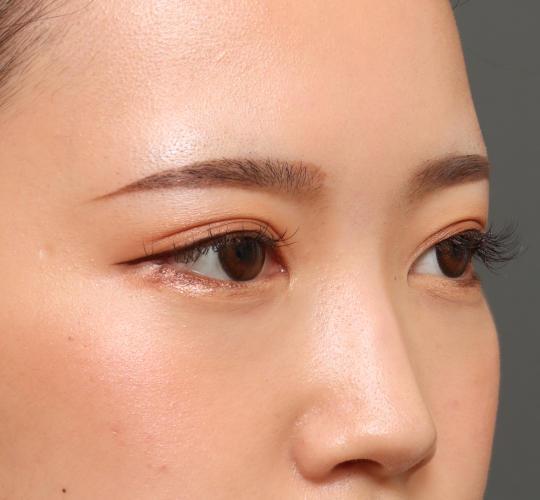 10代女性の目頭切開 After 症例写真