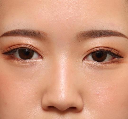 10代女性の目尻切開 After 症例写真