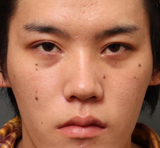 20代男性の目つき矯正 After 症例写真