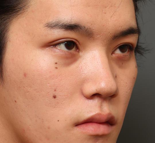 20代男性の目つき矯正 After 症例写真