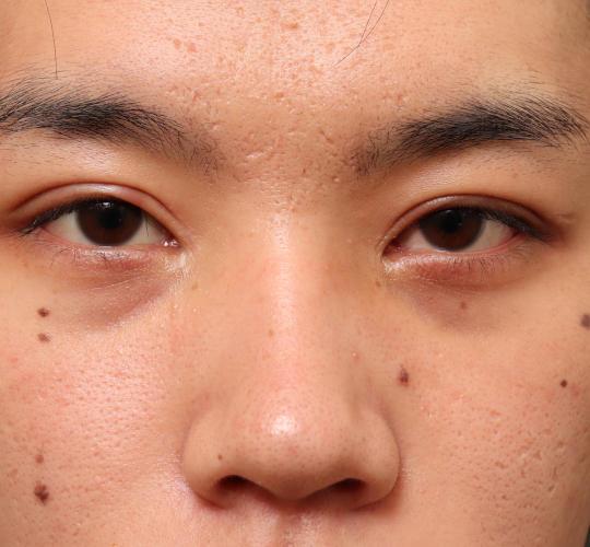 20代男性の目つき矯正 After 症例写真