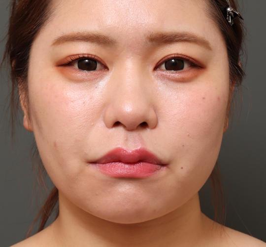 20代女性の顔の脂肪吸引  After 症例写真