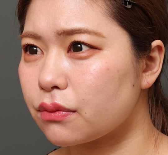 20代女性のVOVリフトプレミアム After 症例写真