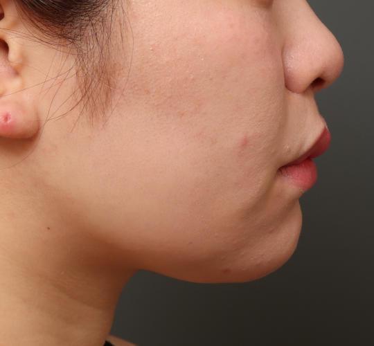 20代女性の顔の脂肪吸引  After 症例写真