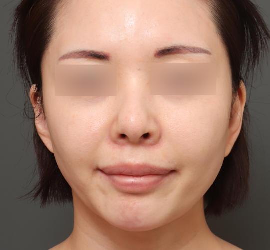 30代女性のグロウHIFUセレクトプラス After 症例写真