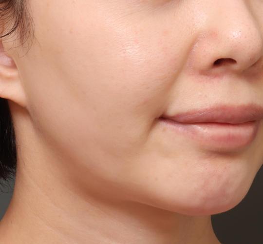 30代女性のグロウHIFUセレクトプラス After 症例写真