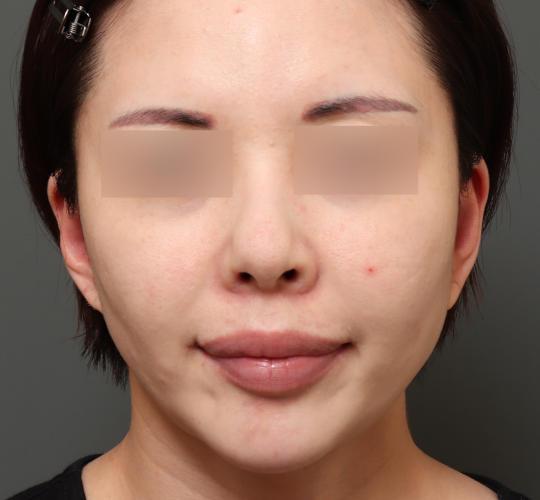 30代女性のグロウHIFUセレクトプラス Before 症例写真