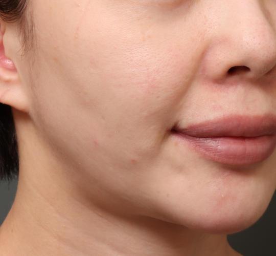 30代女性のグロウHIFUセレクトプラス Before 症例写真