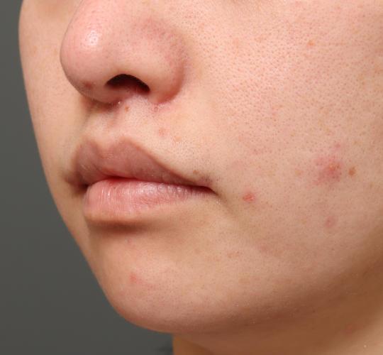 20代女性の人中短縮（リップリフト） After 症例写真