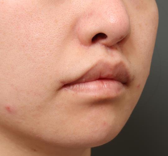 20代女性の唇・口元の整形 After 症例写真