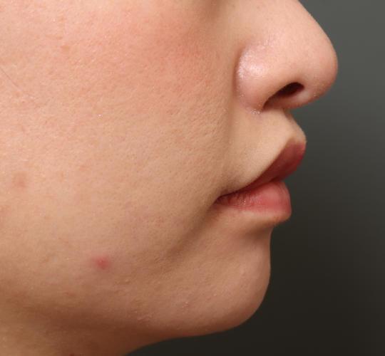 20代女性の人中短縮（リップリフト） After 症例写真