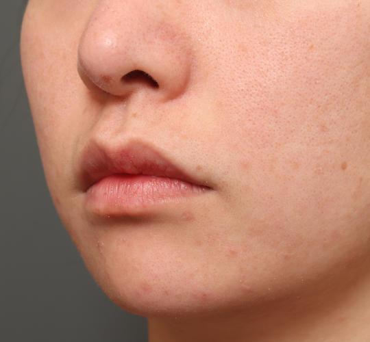 20代女性の人中短縮（リップリフト） Before 症例写真