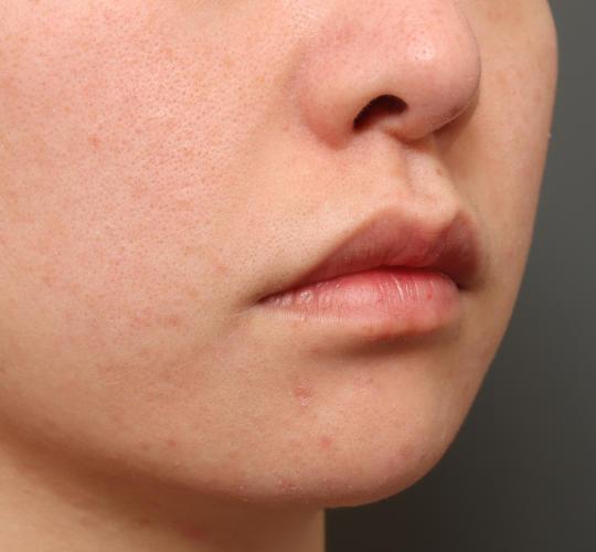 20代女性の唇・口元の整形 Before 症例写真