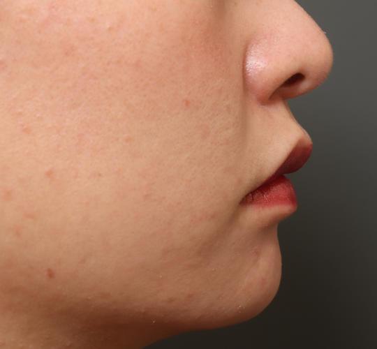 20代女性の人中短縮（リップリフト） Before 症例写真
