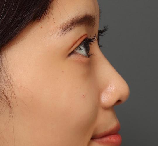 20代女性のヒアルロン酸注射（ゴルゴライン） After 症例写真