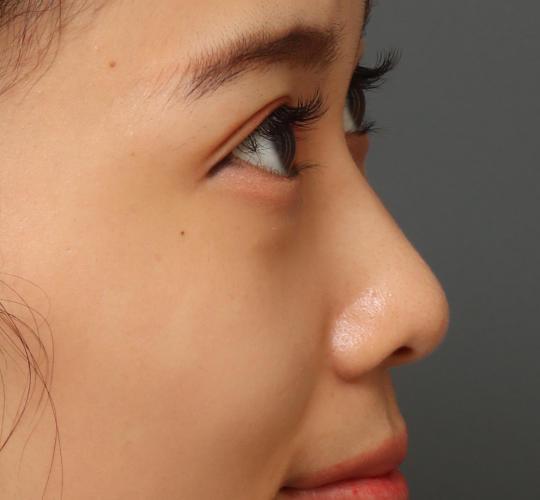 20代女性のヒアルロン酸注射（ゴルゴライン） Before 症例写真