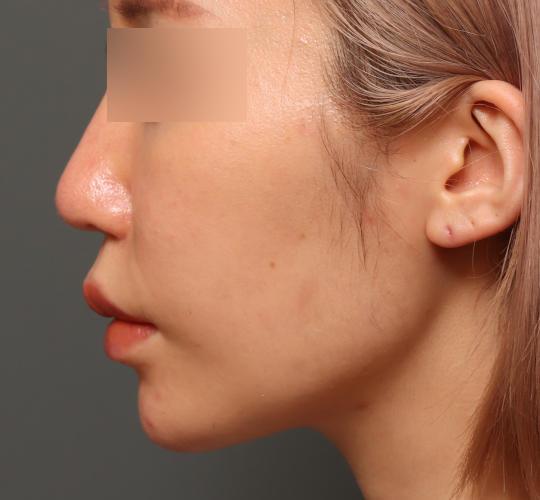 30代女性のヒアルロン酸注射（アゴ形成） After 症例写真