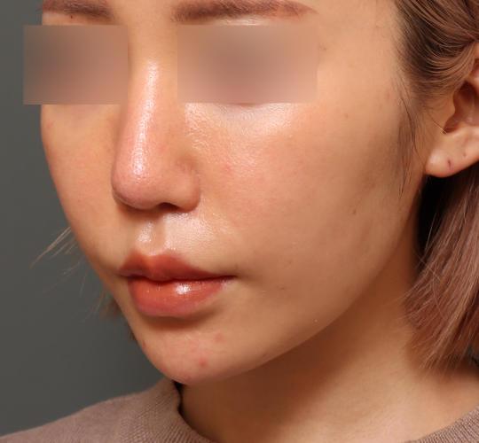 30代女性のヒアルロン酸注射（アゴ形成） After 症例写真