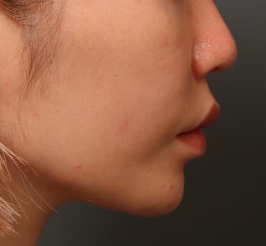 30代女性の唇・口元の整形 After 症例写真