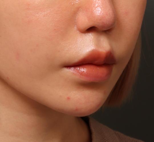 30代女性のヒアルロン酸注射（アゴ形成） After 症例写真