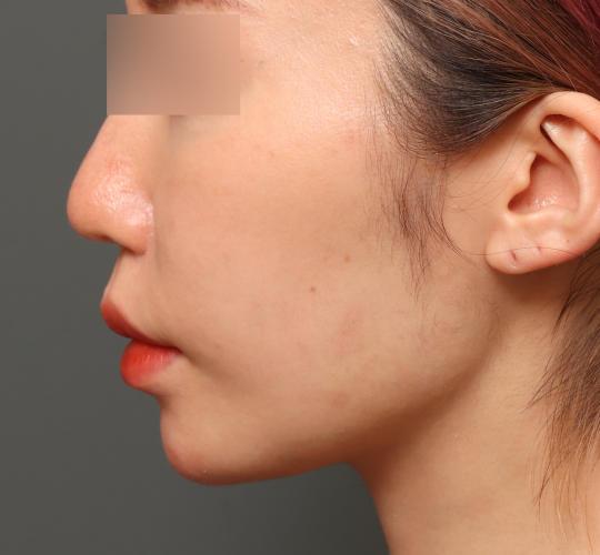 30代女性のヒアルロン酸注射（アゴ形成） Before 症例写真