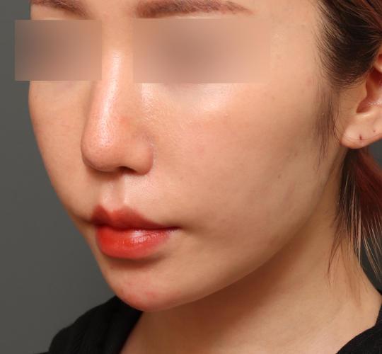 30代女性のヒアルロン酸注射（アゴ形成） Before 症例写真