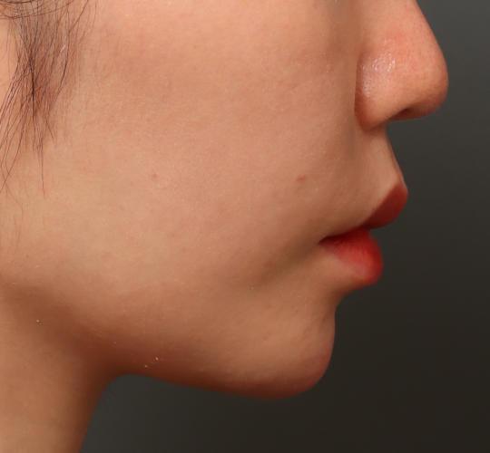 30代女性の唇・口元の整形 Before 症例写真