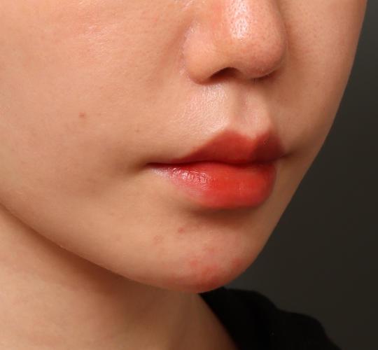 30代女性のヒアルロン酸注射（アゴ形成） Before 症例写真