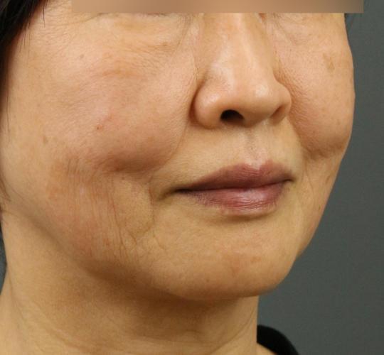 60代女性のヒアルロン酸注射（ゴルゴライン） After 症例写真