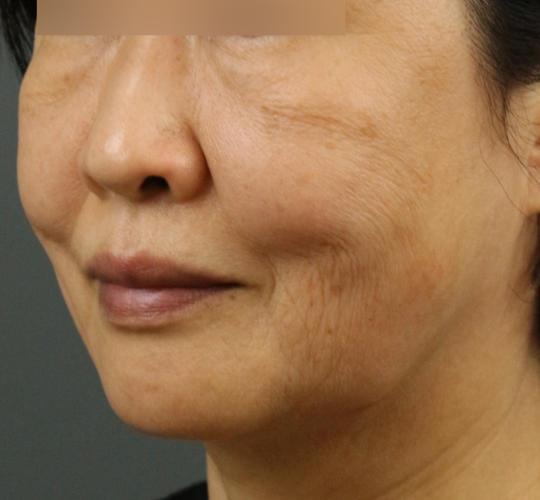 60代女性のヒアルロン酸注射（ゴルゴライン） Before 症例写真