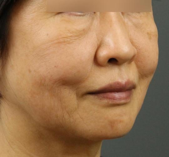 60代女性のヒアルロン酸注射（ゴルゴライン） Before 症例写真