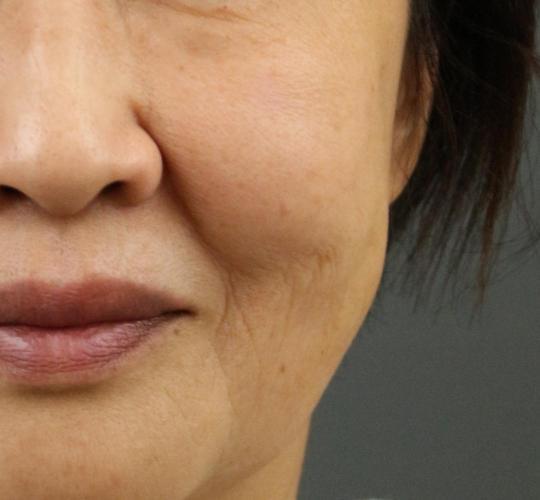 60代女性のシミ・そばかす After 症例写真