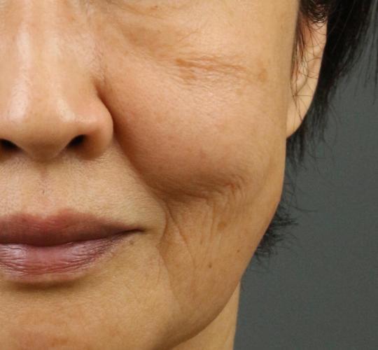 60代女性のシミ・そばかす Before 症例写真