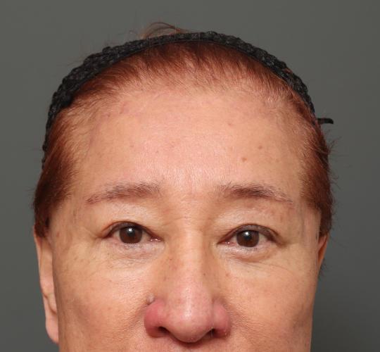 60代男性の生え際前進術 After 症例写真