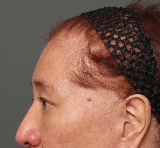 60代男性の生え際前進術 After 症例写真