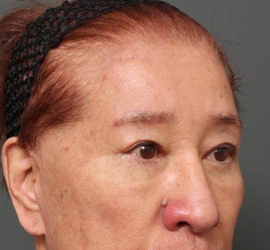 60代男性の二重整形・目元の整形 After 症例写真