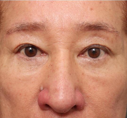 60代男性の生え際前進術 After 症例写真