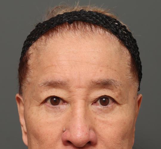 60代男性の生え際前進術 Before 症例写真